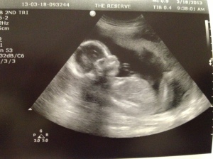 Baby boy at 20 weeks 5 days. 